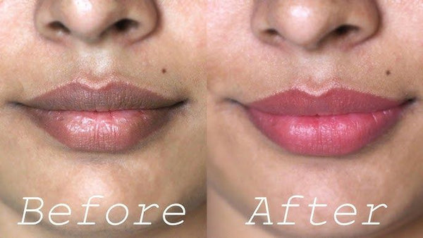 How to Lighten Dark Lips Naturally: Restore Your Lipfidence